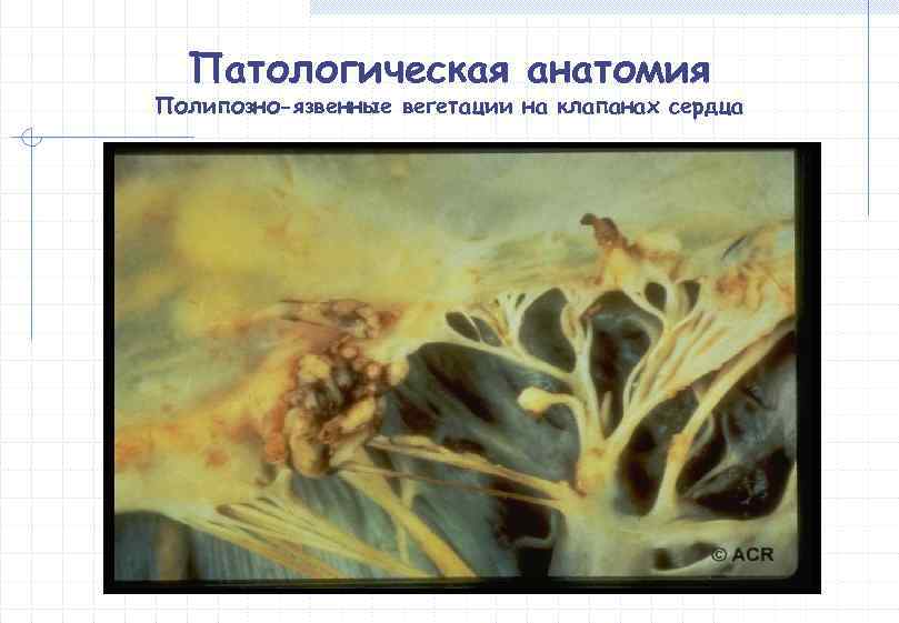  Патологическая анатомия Полипозно-язвенные вегетации на клапанах сердца 