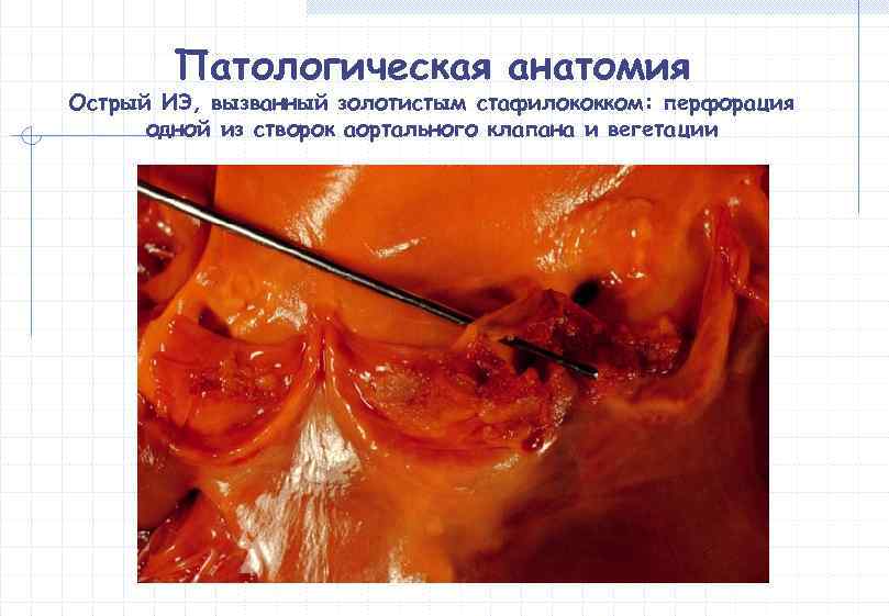   Патологическая анатомия Острый ИЭ, вызванный золотистым стафилококком: перфорация  одной из створок