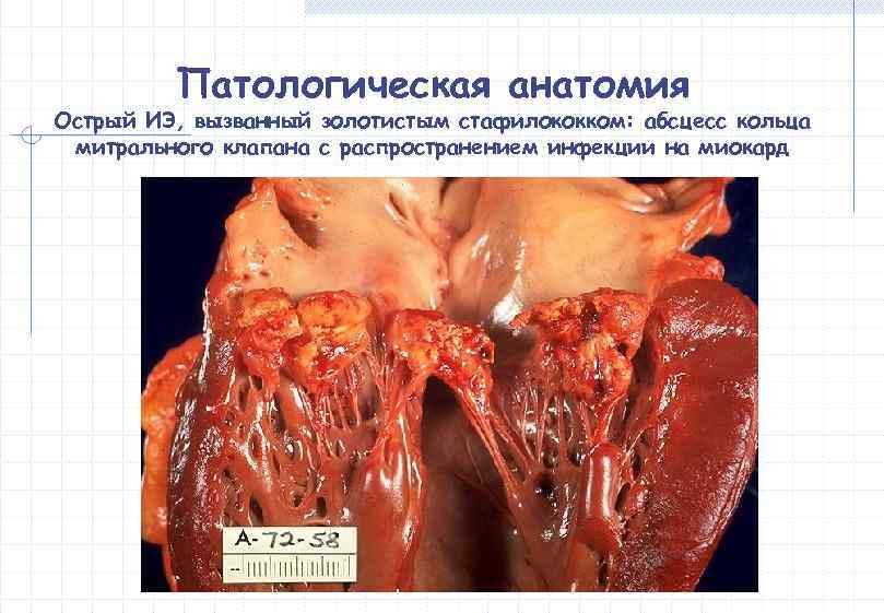    Патологическая анатомия Острый ИЭ, вызванный золотистым стафилококком: абсцесс кольца митрального клапана