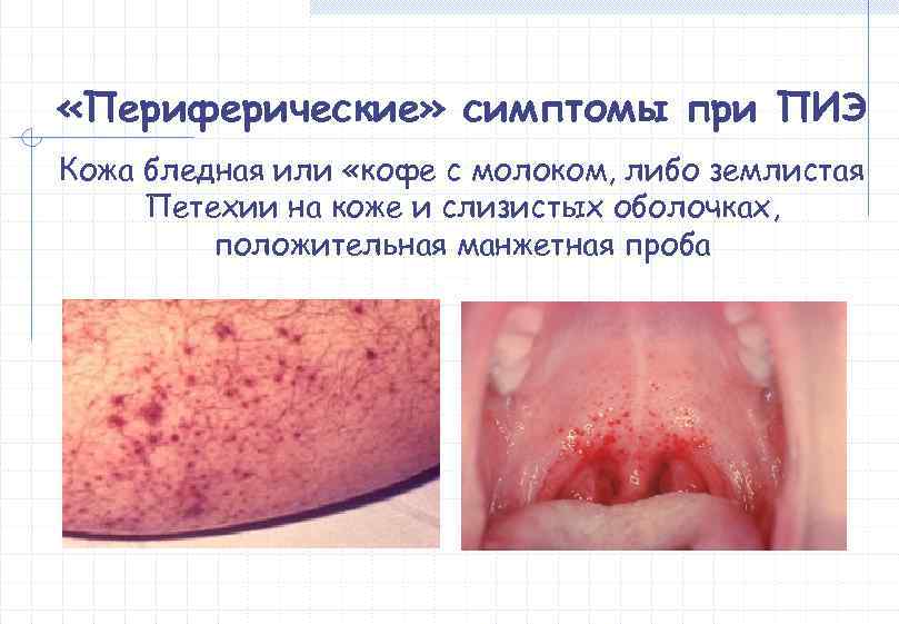  «Периферические» симптомы при ПИЭ Кожа бледная или «кофе с молоком, либо землистая Петехии