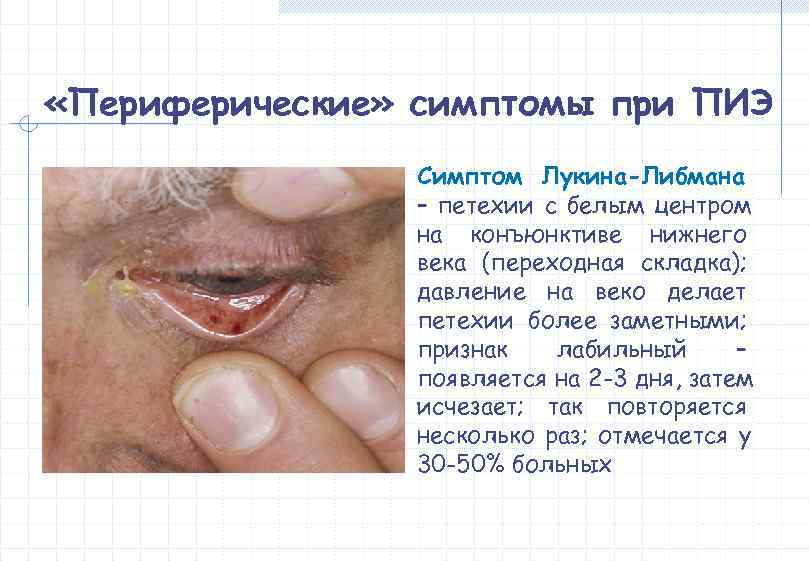  «Периферические» симптомы при ПИЭ   Симптом Лукина-Либмана   – петехии с