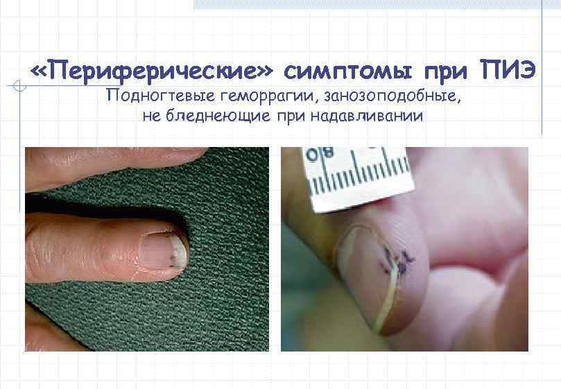 «Периферические» симптомы при ПИЭ Подногтевые геморрагии, занозоподобные,   не бледнеющие при надавливании