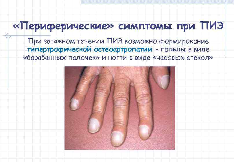  «Периферические» симптомы при ПИЭ  При затяжном течении ПИЭ возможно формирование  гипертрофической