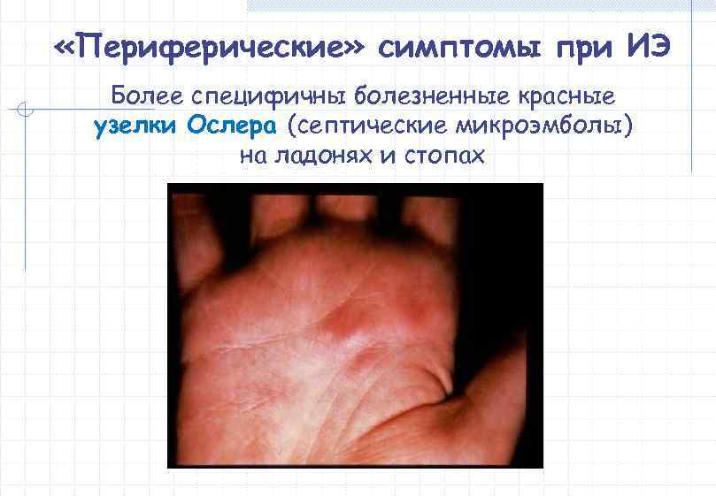  «Периферические» симптомы при ИЭ  Более специфичны болезненные красные  узелки Ослера (септические