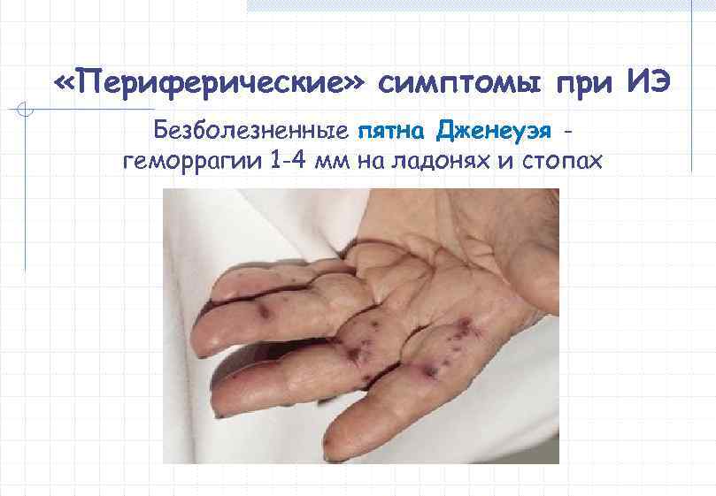  «Периферические» симптомы при ИЭ Безболезненные пятна Дженеуэя -  геморрагии 1 -4 мм
