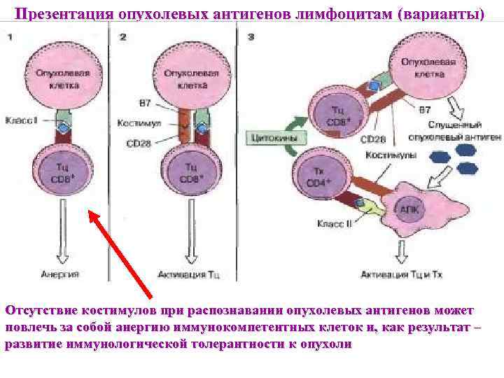  Презентация опухолевых антигенов лимфоцитам (варианты) Отсутствие костимулов при распознавании опухолевых антигенов может повлечь