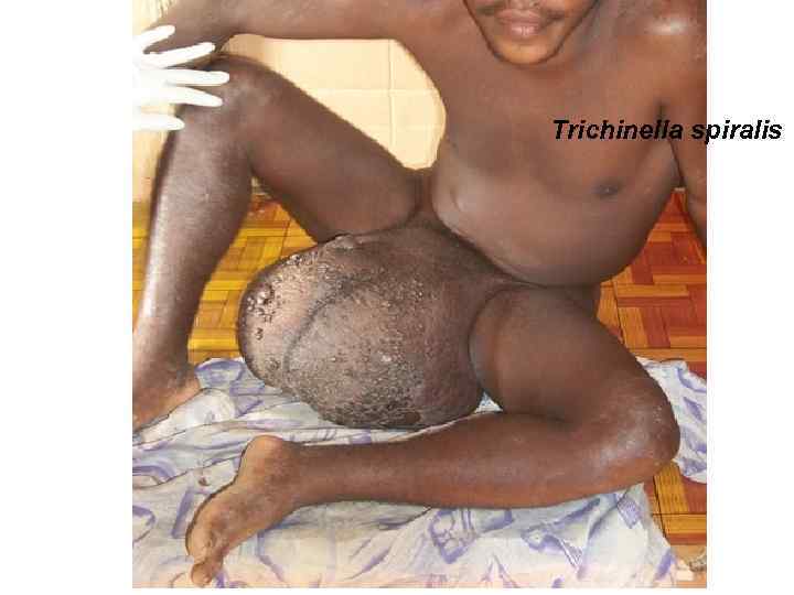 Trichinella spiralis 