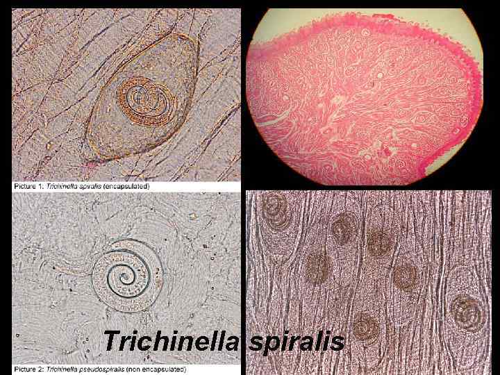 Trichinella spiralis 