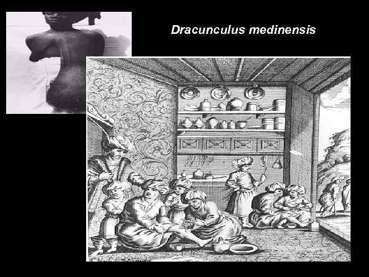 Dracunculus medinensis 