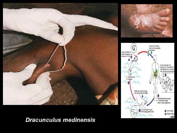 Dracunculus medinensis 
