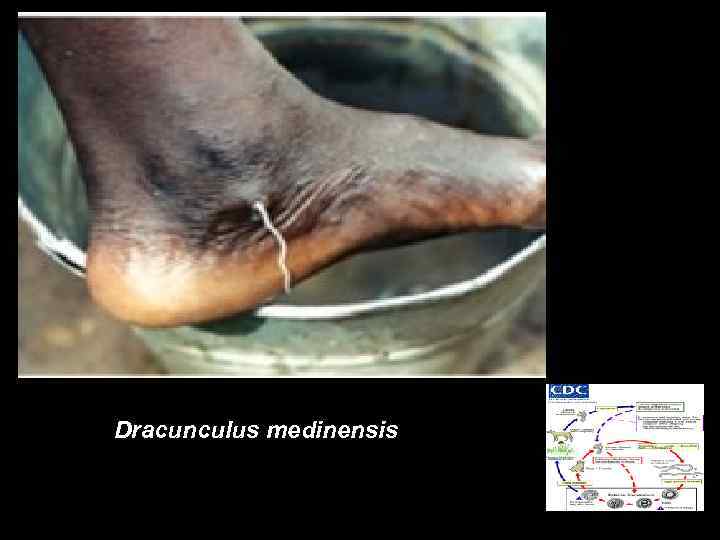 Dracunculus medinensis 