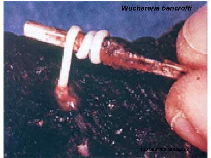 Wuchereria bancrofti   120 000 заражено 