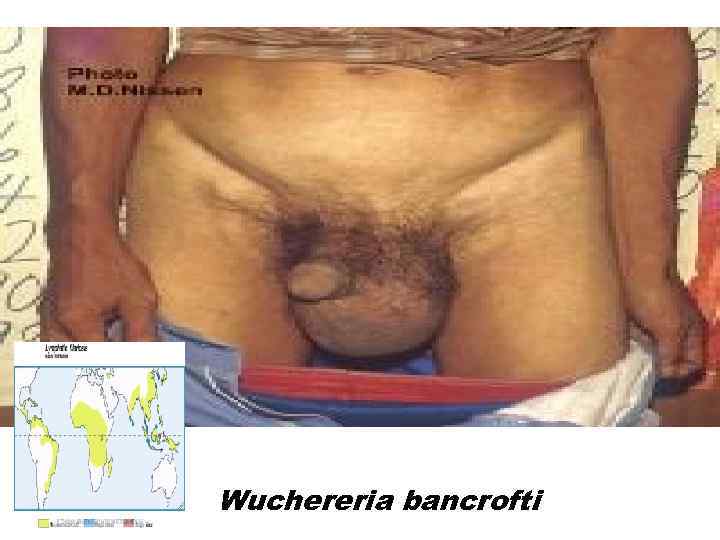 Wuchereria bancrofti 