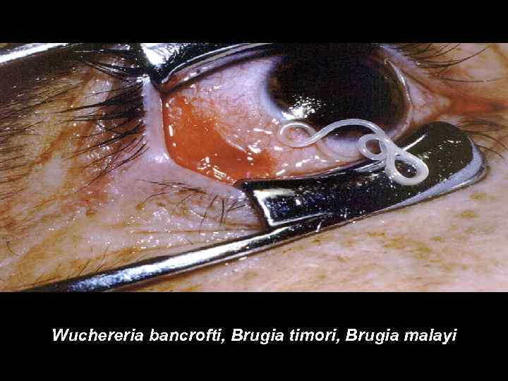 Wuchereria bancrofti, Brugia timori, Brugia malayi 