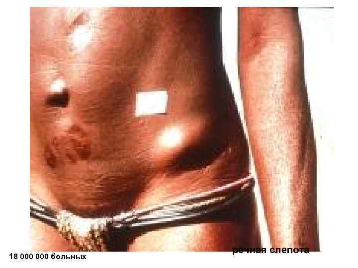      речная слепота 18 000 больных 