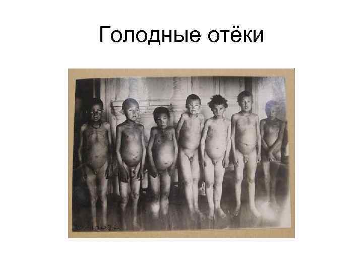 Голодные отёки 