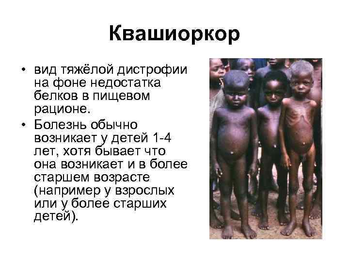    Квашиоркор • вид тяжёлой дистрофии  на фоне недостатка  белков