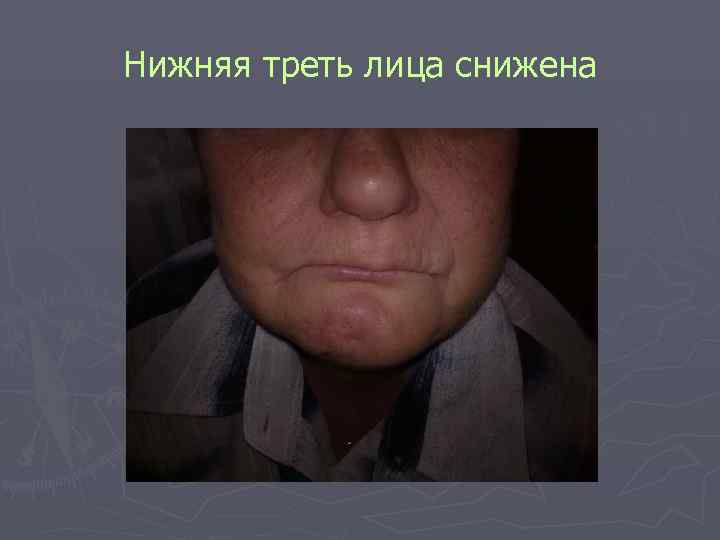 Нижняя треть лица снижена Нижняя треть лица снижена