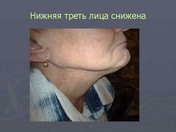 Нижняя треть лица снижена Нижняя треть лица снижена