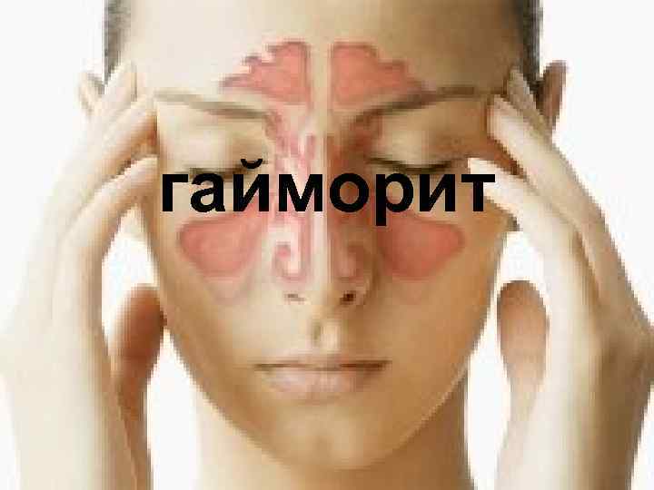 гайморит 