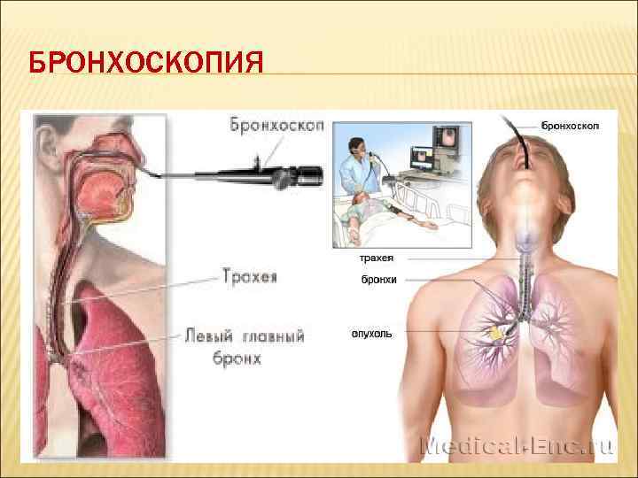 Бронхоскопия легких