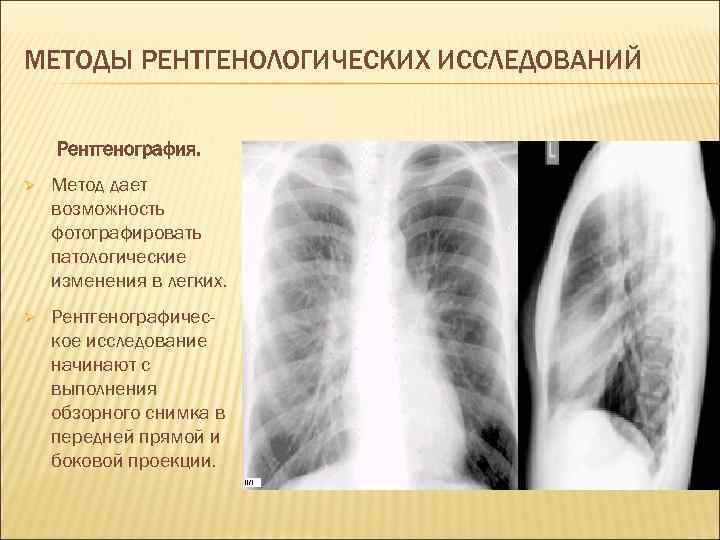МЕТОДЫ РЕНТГЕНОЛОГИЧЕСКИХ ИССЛЕДОВАНИЙ  Рентгенография. Ø  Метод дает возможность фотографировать патологические изменения в