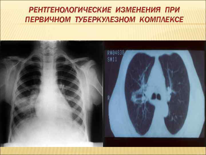  РЕНТГЕНОЛОГИЧЕСКИЕ ИЗМЕНЕНИЯ ПРИ ПЕРВИЧНОМ ТУБЕРКУЛЕЗНОМ КОМПЛЕКСЕ 