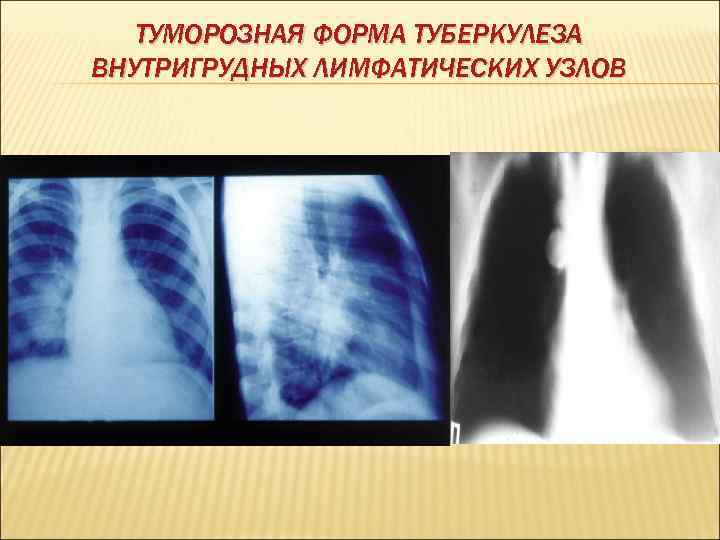   ТУМОРОЗНАЯ ФОРМА ТУБЕРКУЛЕЗА ВНУТРИГРУДНЫХ ЛИМФАТИЧЕСКИХ УЗЛОВ 