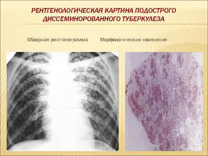  РЕНТГЕНОЛОГИЧЕСКАЯ КАРТИНА ПОДОСТРОГО ДИССЕМИНОРОВАННОГО ТУБЕРКУЛЕЗА Обзорная рентгенограмма  Морфологические изменения 