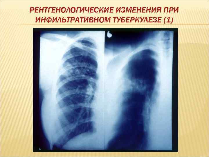 РЕНТГЕНОЛОГИЧЕСКИЕ ИЗМЕНЕНИЯ ПРИ ИНФИЛЬТРАТИВНОМ ТУБЕРКУЛЕЗЕ (1) 