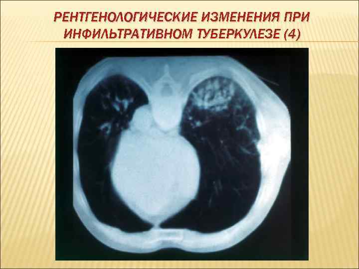 РЕНТГЕНОЛОГИЧЕСКИЕ ИЗМЕНЕНИЯ ПРИ ИНФИЛЬТРАТИВНОМ ТУБЕРКУЛЕЗЕ (4) 