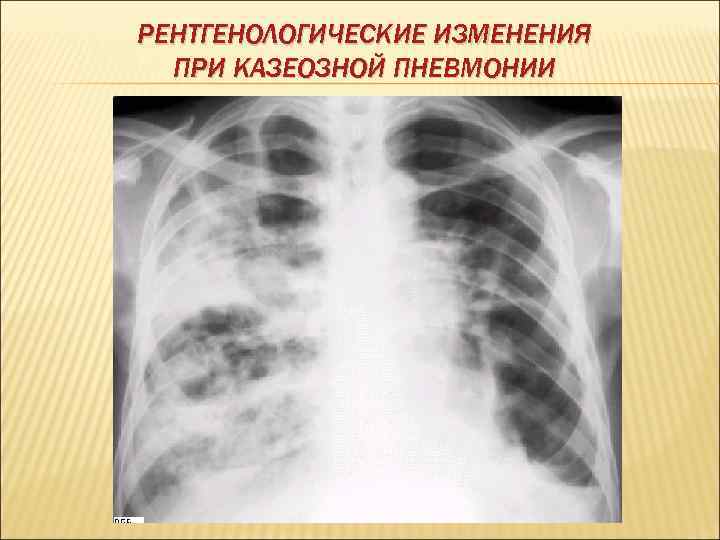 РЕНТГЕНОЛОГИЧЕСКИЕ ИЗМЕНЕНИЯ  ПРИ КАЗЕОЗНОЙ ПНЕВМОНИИ 
