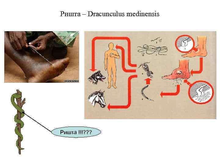 Ришта – Dracunculus medinensis Ришта !!!? ? ? 