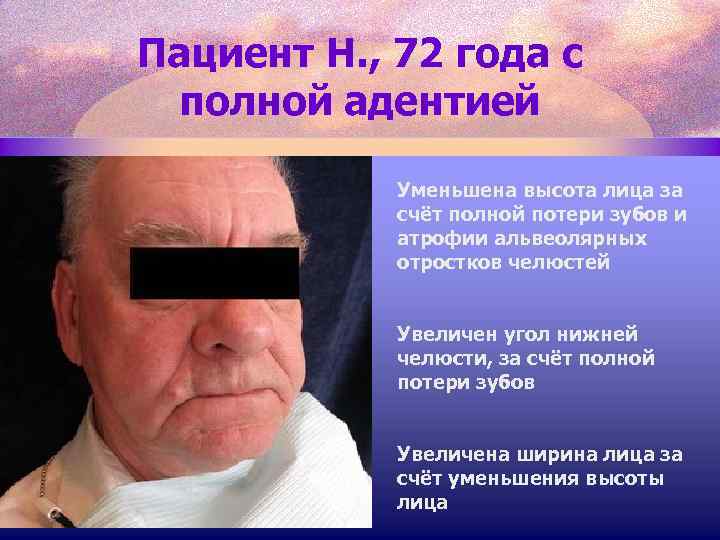 Пациент Н. , 72 года с полной адентией Уменьшена высота лица за счёт полной