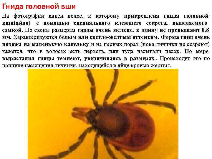 Гнида головной вши На фотографии виден волос, к которому прикреплена гнида головной вши(яйцо) Гнида головной вши На фотографии виден волос, к которому прикреплена гнида головной вши(яйцо)