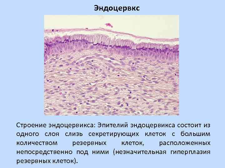 Эндометрия эндоцервикса. Железистая гиперплазия гистология. Железисто-кистозная гиперплазия гистология. Атипичная гиперплазия эндометрия гистология. Эндометриальный полип матки гистология.