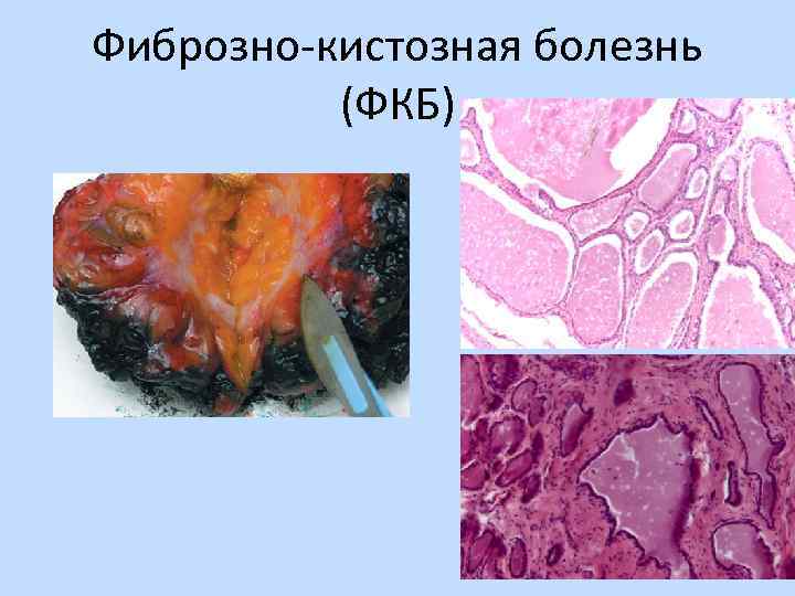 Фиброзно-кистозная болезнь (ФКБ) 