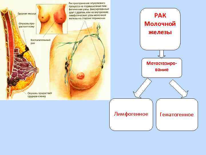 РАК Молочной железы Метастазирование Лимфогенное Гематогенное 