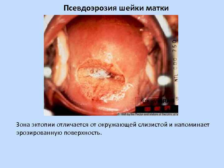Псевдоэрозия шейки матки Зона эктопии отличается от окружающей слизистой и напоминает эрозированную поверхность. 