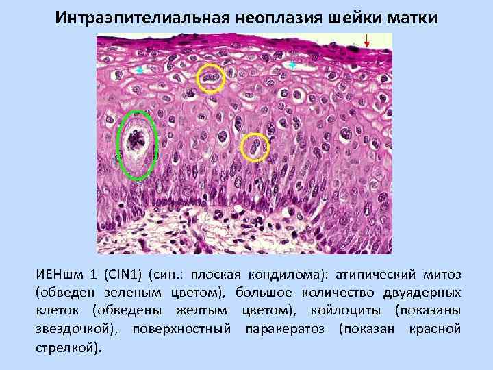 Интраэпителиальное поражение клетки