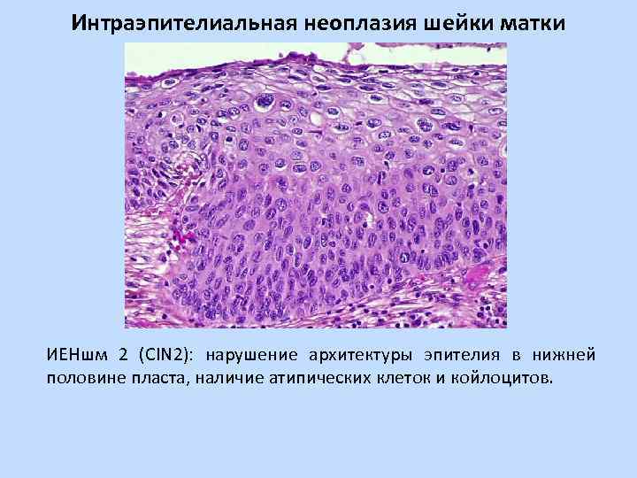 Интраэпителиальная неоплазия шейки матки ИЕНшм 2 (CIN 2): нарушение архитектуры эпителия в нижней половине