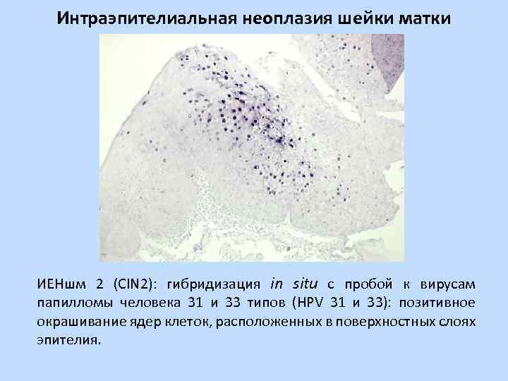 Интраэпителиальное поражение hsil. Интраэпителиальная неоплазия. Цервикальная интраэпителиальная неоплазия (Cin). Цервикальная интраэпителиальная неоплазия 2 степени шейки матки. Неоплазия железистого эпителия шейки матки.