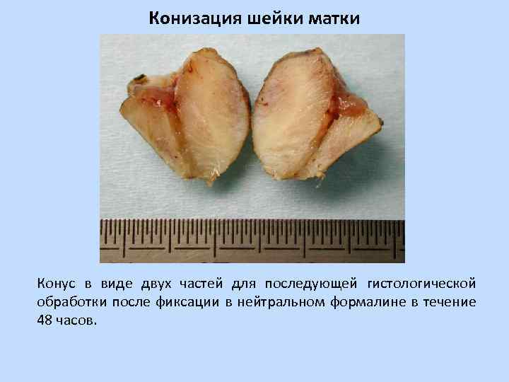 Конизация шейки матки Конус в виде двух частей для последующей гистологической обработки после фиксации