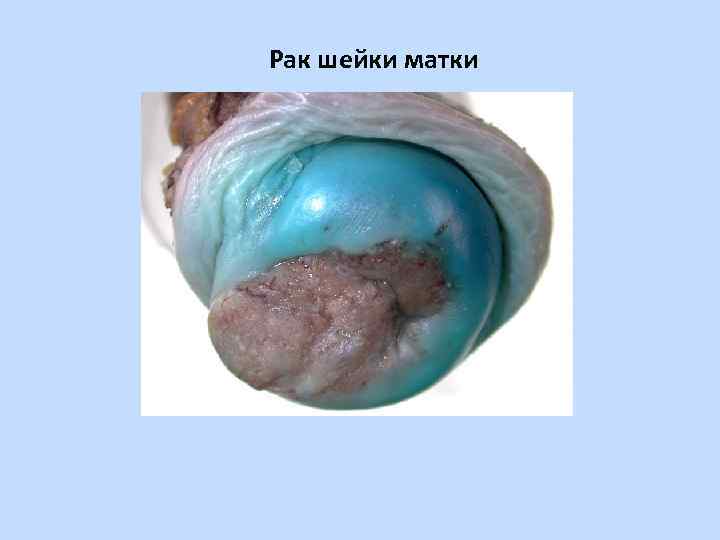 Рак шейки матки 