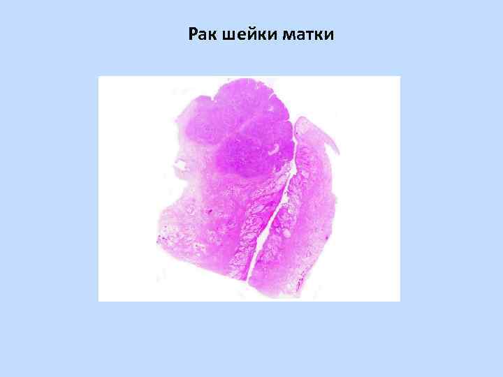 Рак шейки матки 