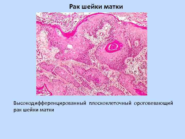 Плоскоклеточный неороговевающий рак шейки