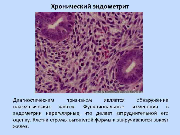 Строма эндометрия с фиброзом