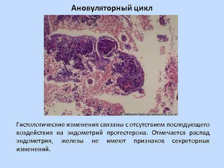 Ановуляторный цикл Гистологические изменения связаны с отсутствием последующего воздействия на эндометрий прогестерона. Отмечается распад