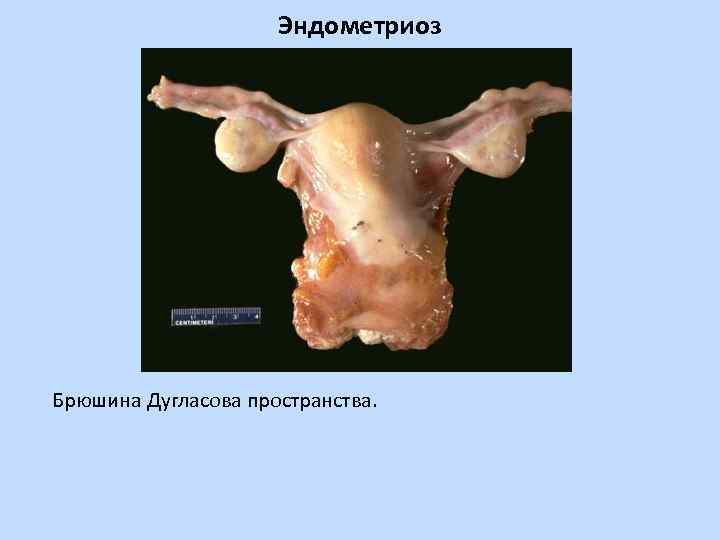 Эндометриоз Брюшина Дугласова пространства. 