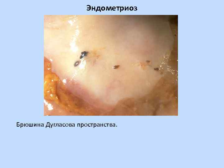 Эндометриоз Брюшина Дугласова пространства. 